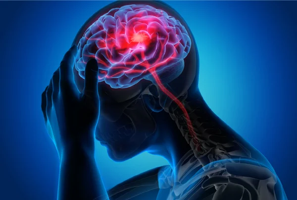 Stroke Hemiplegia