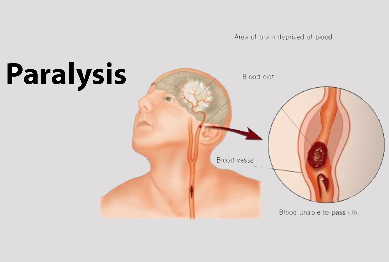 Paralysis