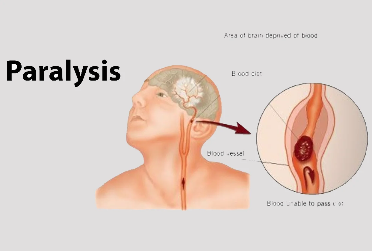 Paralysis