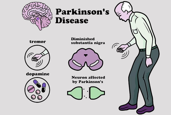 Parkinsons Disease