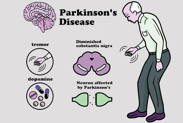 Parkinsons Disease
