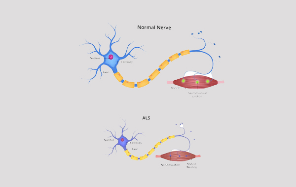 Amyotrophic Lateral Sclerosis