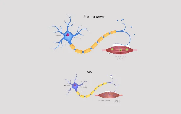 Amyotrophic Lateral Sclerosis