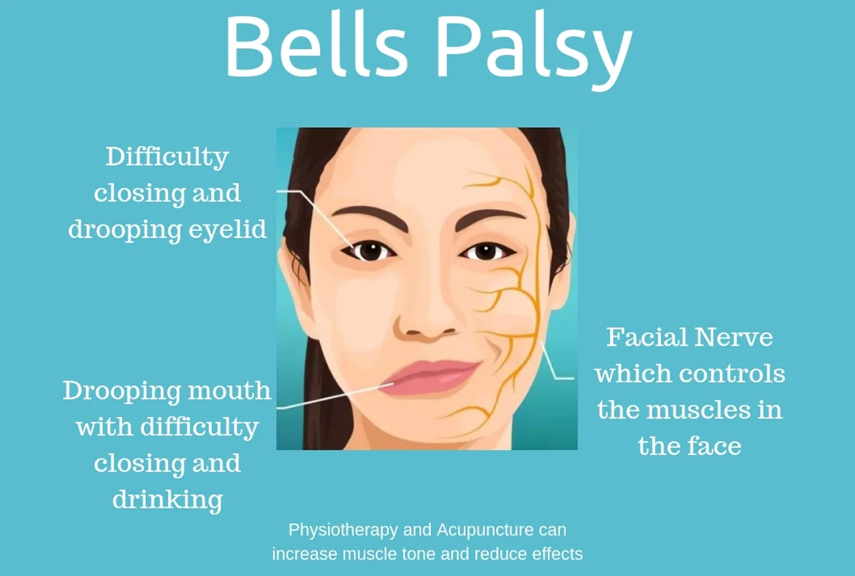 Bells Palsy