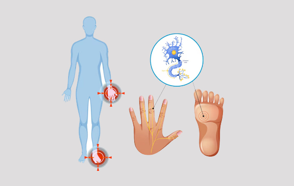 Diabetic Neuropathy