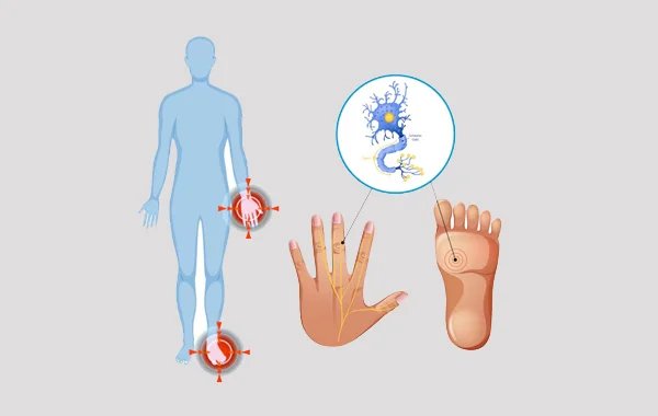 Diabetic Neuropathy