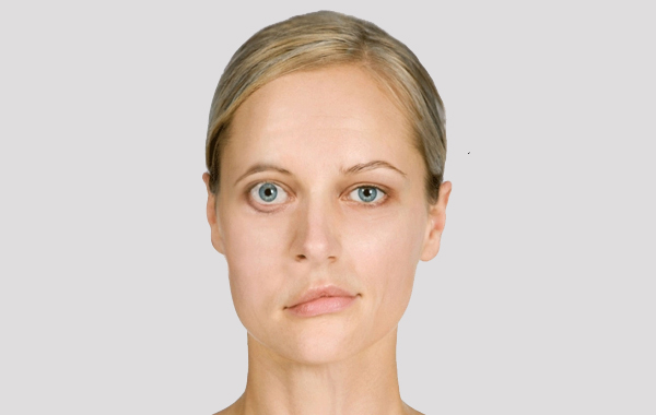 Myasthenia Gravis
