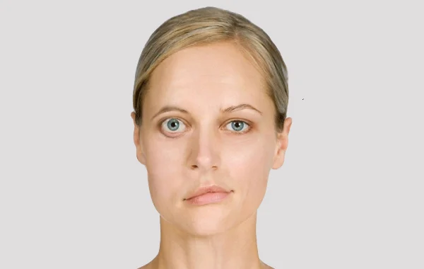 Myasthenia Gravis