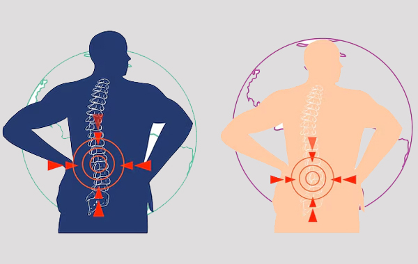 Cauda Equina Syndrome