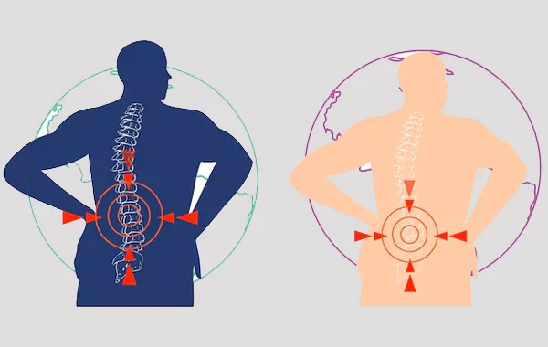 Cauda Equina Syndrome
