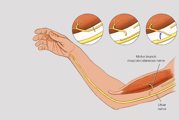 Sciatic Nerve Injury