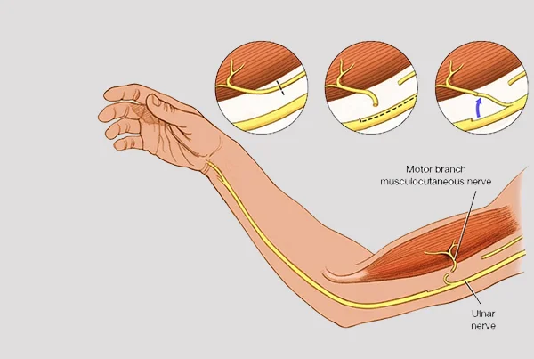 Sciatic Nerve Injury