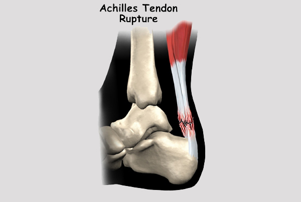 Achilles Tendinopathy