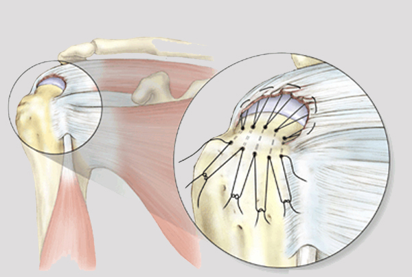 Rotator Cuff Tendinopathy