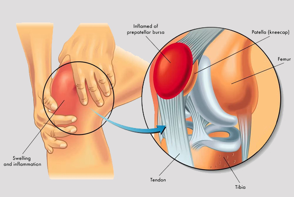 Common Tendon Injuries