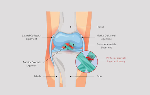 PCL Injury Knee