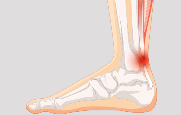 Lateral Ligament Injury Ankle