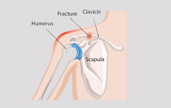 Clavicular Fracture