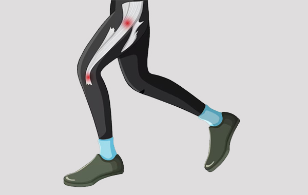 Iliotibial Band Syndrome