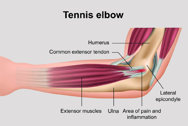 Tennis Elbow